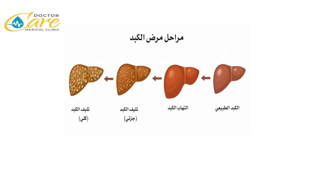 هل تليف الكبد يسبب الوفاة