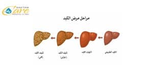 هل تليف الكبد يسبب الوفاة