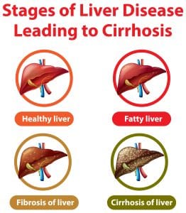 علاج تليف الكبد البسيط